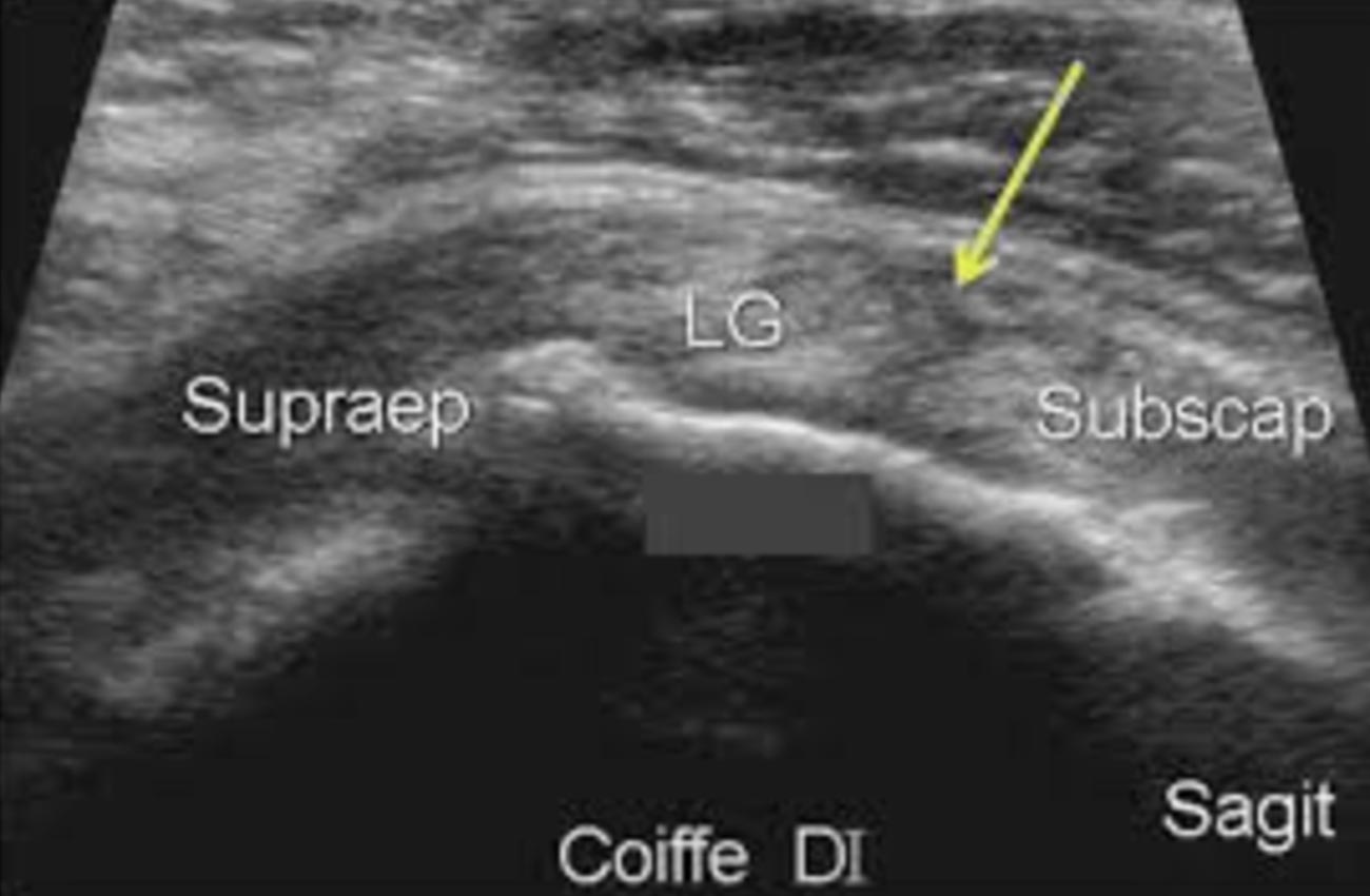 Échographie d'une épaule