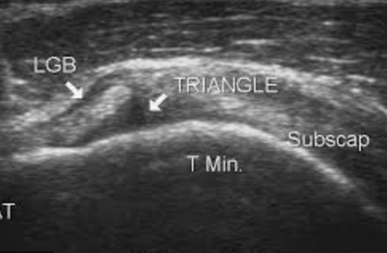 Échographie d'une épaule
